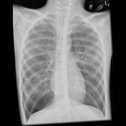 x ray for asthma|Asthma (summary) .